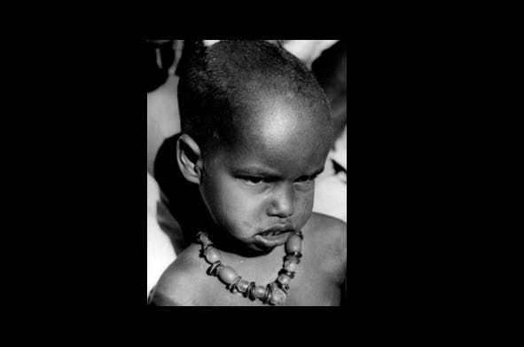 أمين سالات، آخر حالة مصابة بالجدري في إثيوبيا عام 1976