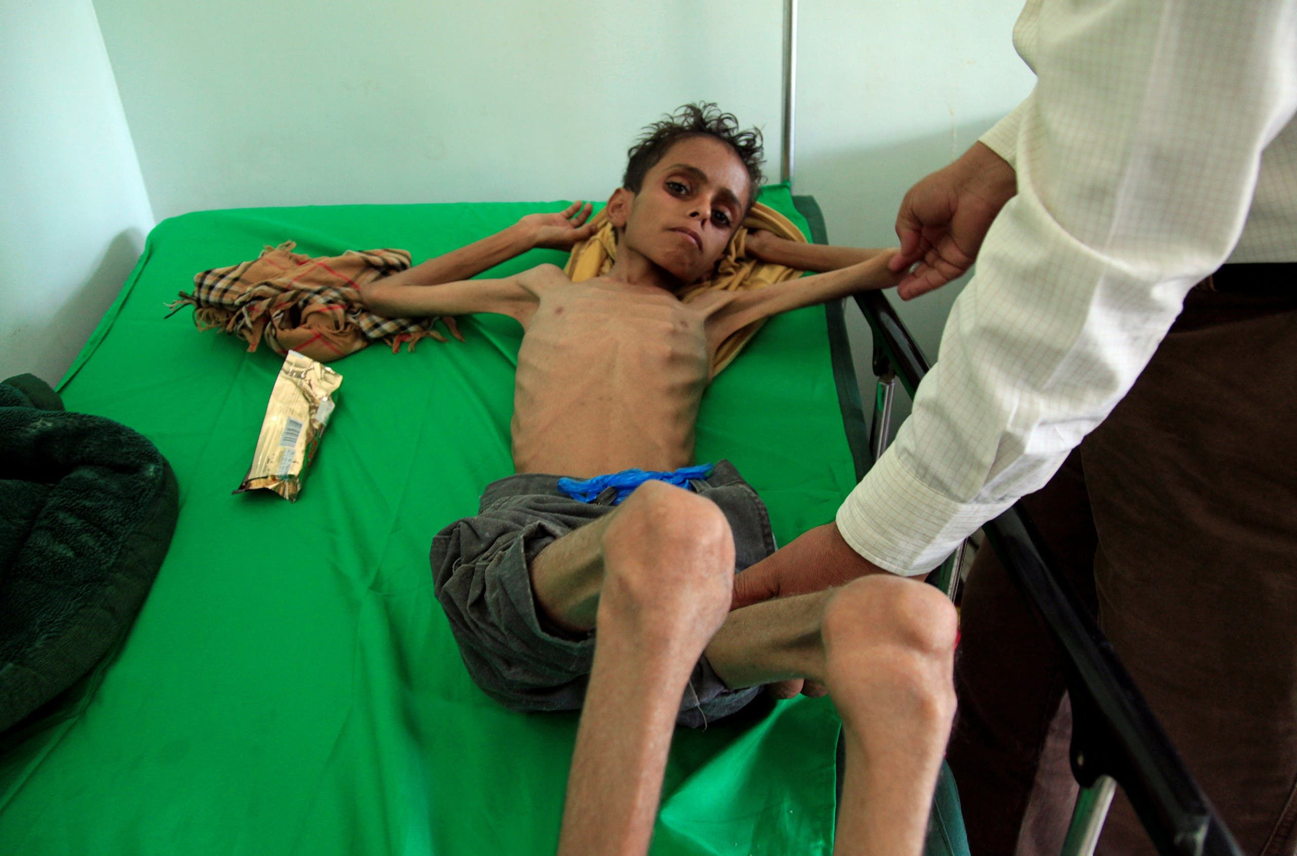 طفل في مستشفى بتعز يعاني من سوء التغذية