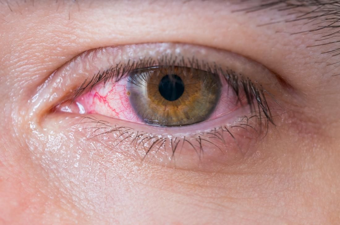التهاب ملتحمة العين 2