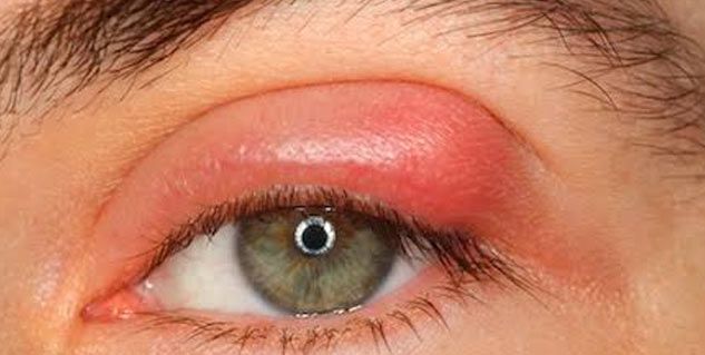 التهاب العين الأمامية