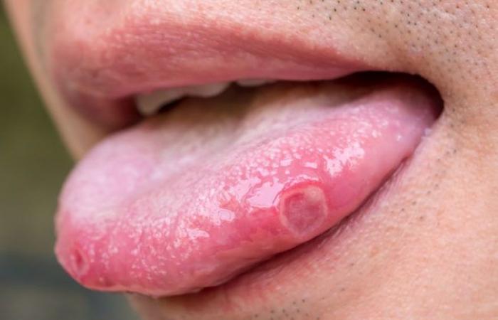 استمرار التهاب الفم أكثر من أسبوعين قد يكون علامة على الإصابة بالسرطان