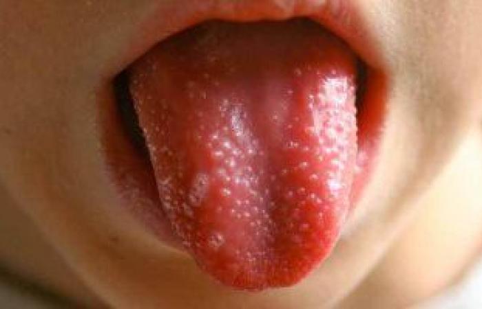 خبراء بريطانيون: التهاب اللسان قد يكون من أعراض فيروس كورونا الأكثر انتشار