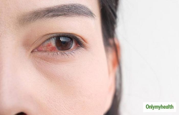 علاج العين بعد دخول حشرة أو جسم غريب.. لا تستخدم قطنة ولا تفرك عينيك