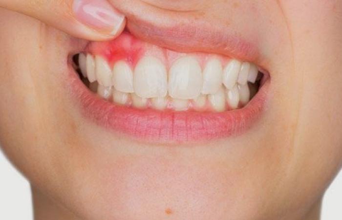 دراسة: عدوى اللثة والأسنان تسبب ارتفاع ضغط الدم