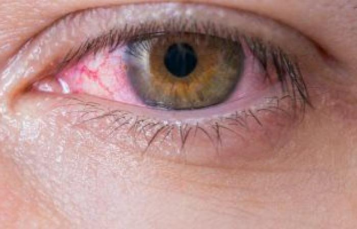لماذا تصاب بالتهاب ملتحمة العين وما أبرز أعراضها وأنواعها؟