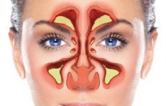تعرف على أعراض التهاب الجيوب الأنفية أبرزها رائحة الفم الكريهة والصداع