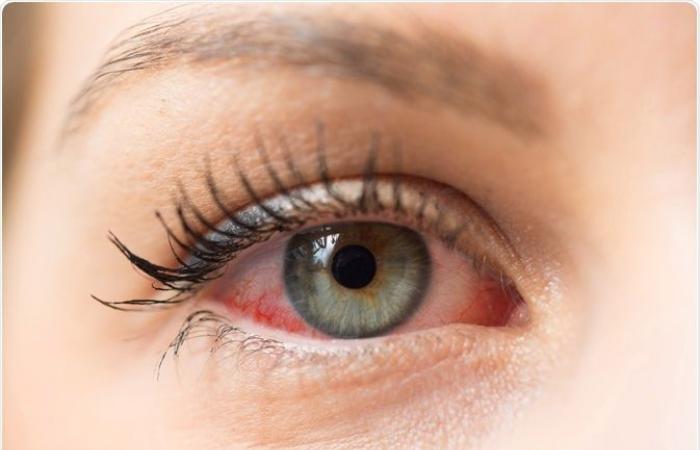 كل ما تريد معرفته عن أعراض وأسباب حساسية العين