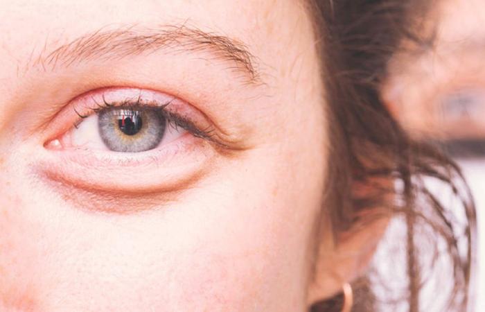 علاج الانتفاخ تحت العين بطرق عدة منها الكمادات الباردة