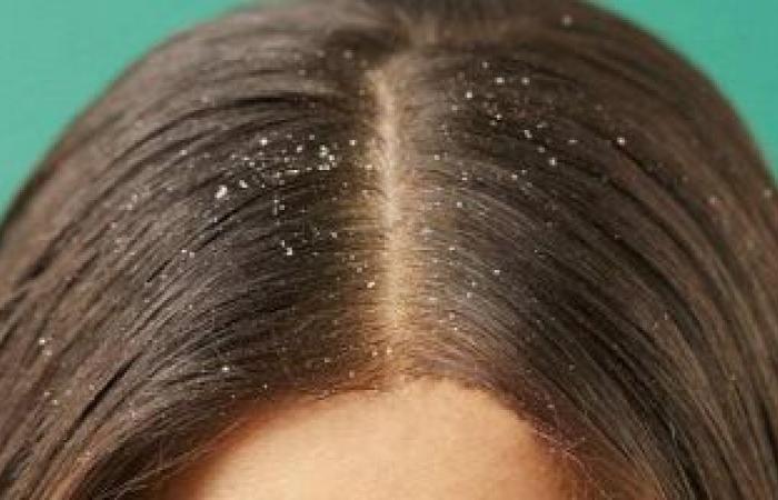 4 أسباب وراء انتشار قشرة الشعر.. تعرف على طرق العلاج