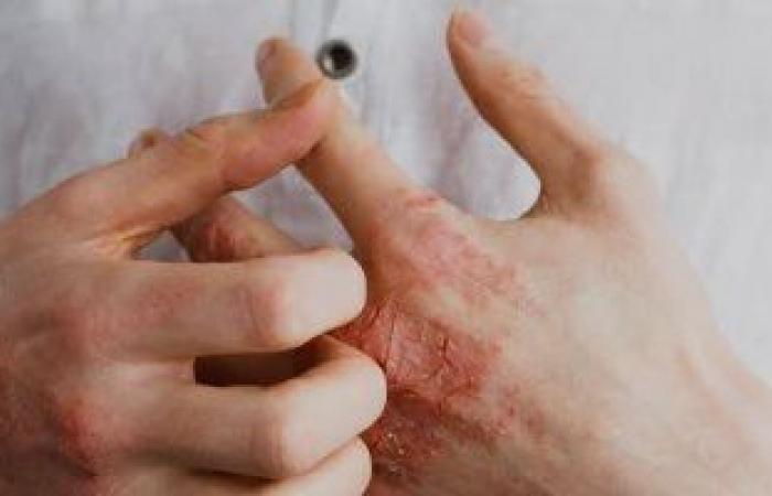 أعراض سرطان الجلد المبكرة عديدة.. أبرزها ظهور قرح لا تلتئم