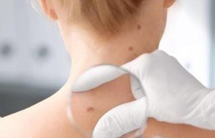 دراسة بلجيكية: المضادات الحيوية تساعد فى علاج سرطان الجلد