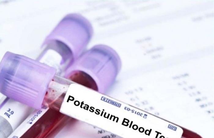 أعراض إذا ظهرت عليك يجب إجراء تحليل بوتاسيوم الدم.. تعرف عليها