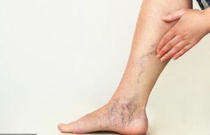 أسباب وعوامل تزيد من خطر الإصابة بدوالى الساقين