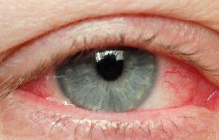أعراض فيروس كورونا في العين منها التهاب الملتحمة والألم