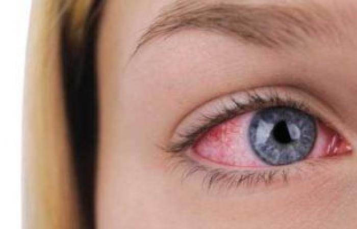 ما هى أسباب احمرار العين المستمر وطرق علاجها؟