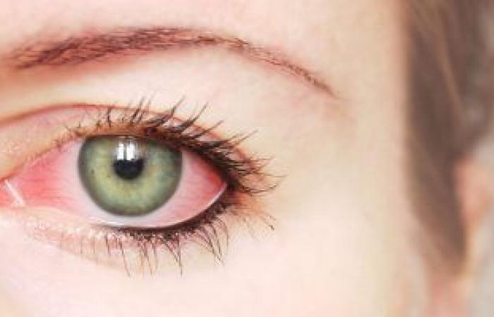 كيف تفرق بين أعراض العين الوردية والحساسية؟