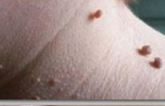 الزوائد الجلدية علامة تحذيرية لمرض السكرى.. اعرف أسباب ظهورها