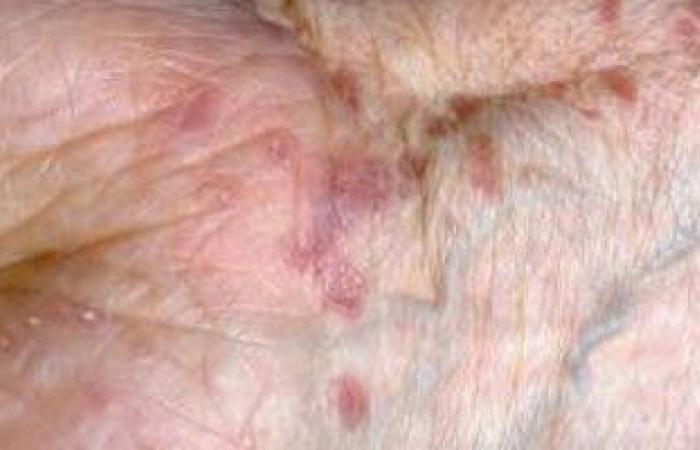 "الحزاز المتصلب" يصيب الجلد بالبقع البيضاء وأبرز أعراضه الاحمرار والحكة