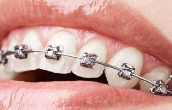 حلول وطرق مختلفة لعلاج مشاكل الأسنان .. أبرزها الفينير