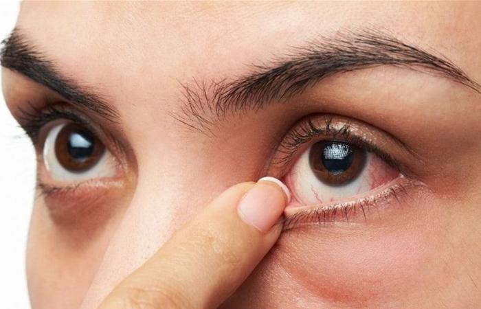 جفاف العين يؤثر سلبًا على الصحة الجسدية والعقلية