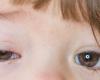 ما أسباب التهاب 'ملتحمة العين' لدى الأطفال؟