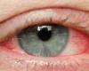 تعرف على الفرق بين عدوى العين الفيروسية والبكتيرية وطرق العلاج