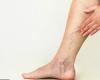 5 أعراض لدوالى الساقين.. انتشار عروق زرقاء وحكة والتهاب الجلد