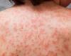 ديلى ميل: 21% من مصابى كورونا يظهر عليهم الطفح الجلدى ضمن الأعراض