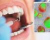 دراسة: عدم تنظيف أسنانك قد يزيد من خطر الإصابة بالسرطان