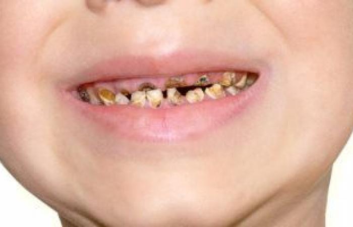 أسباب تسوس الأسنان لدى الأطفال وطرق الوقاية